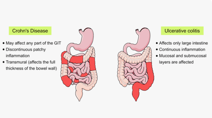 Can CBD Help Crohn’s Disease or Ulcerative Colitis?