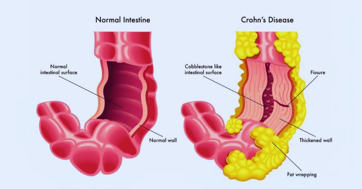 The Best Edibles for Crohn's-disease