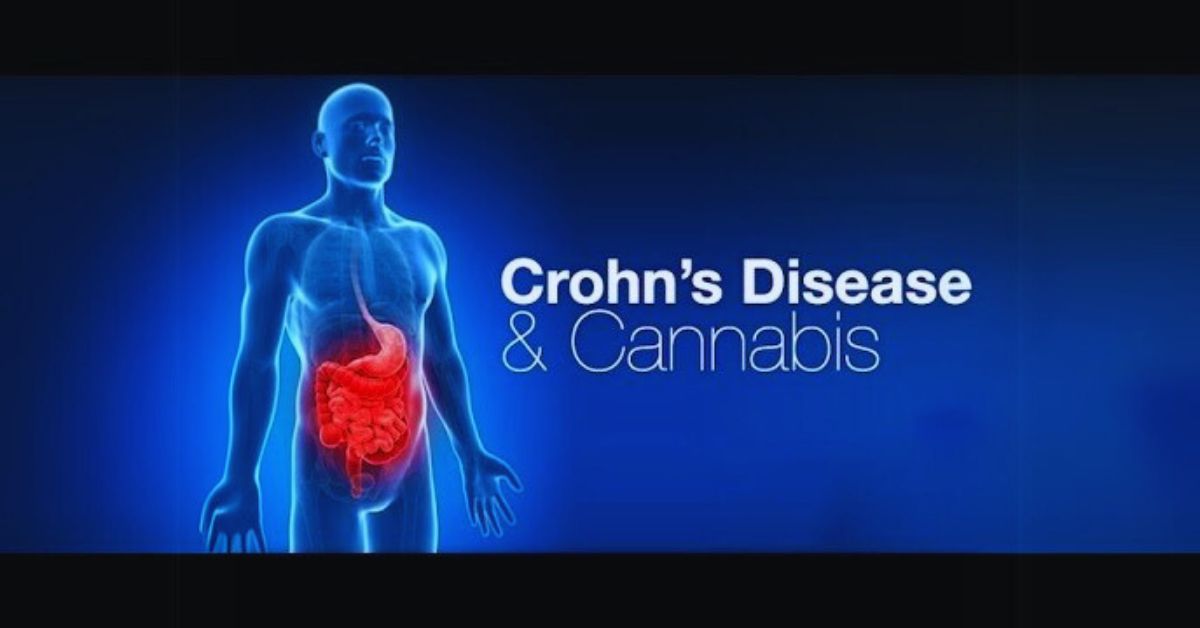 CBD for Crohn's | Crohn's Disease Cannabinoid Receptors